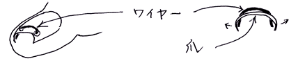 超弾性ワイヤーによる矯正